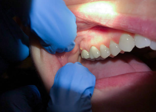 Best Emergency Dentist for Knocked-Out Tooth in North Shore, VA